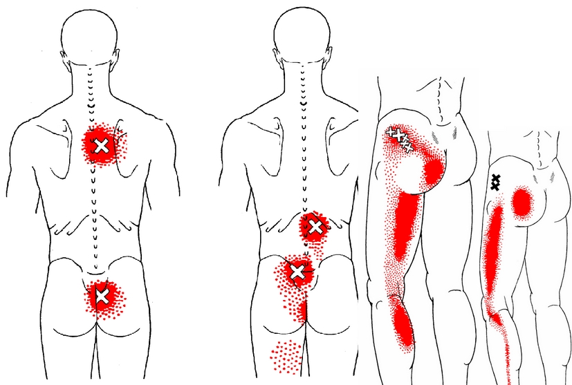 Триггерные точки на ногах схема